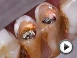 Screw Retained Zirganic vs Screw Retained Denture
